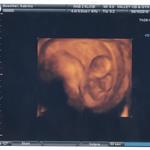 3D Ultrasound 10wks 4 days