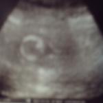 14w4d, old ultrasound equipment, the baby was moving so much, hard to get a pic