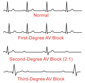 EKG's showing AV Blocks (Heart Block)