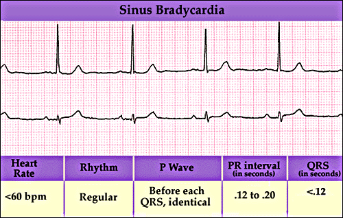 EKG displaying Bradycardia