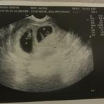 7 week u/s of the twins. Yes ladies I said twins and not triplets!! lol
