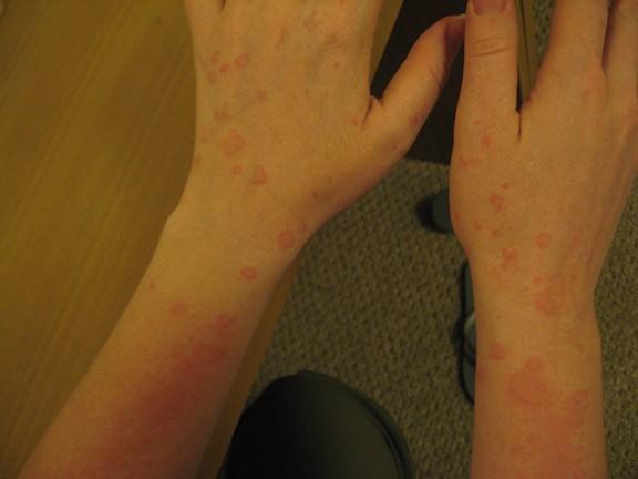 Allergic Reaction or Contact Dermatitis? 