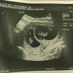 9 Week u/s of the Twins - Baby B is lying the opposite direction