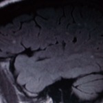 My MRI