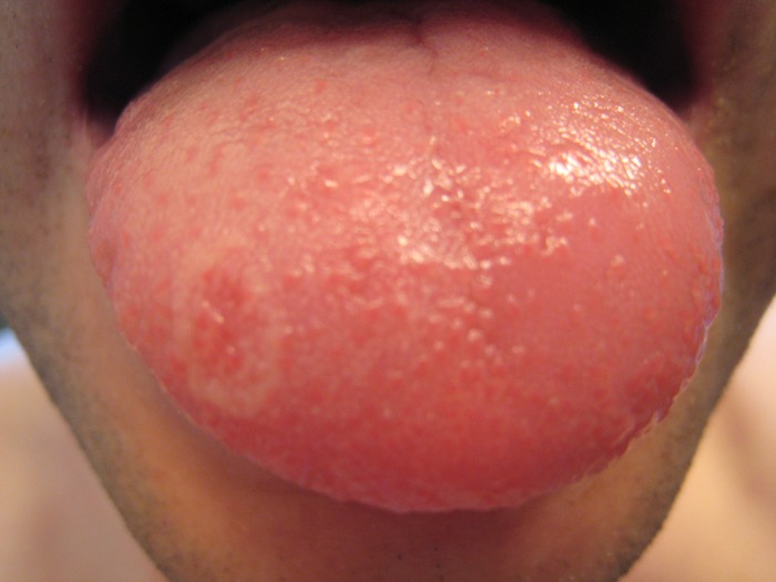 my tongue is this geographic tongue ?