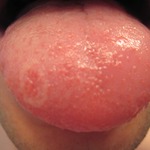 my tongue is this geographic tongue ?