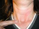 thyroid scar 3yrs post-op
