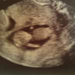 12 Week u/s Baby B with hand in face