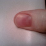 Thumb after close encounter with car door