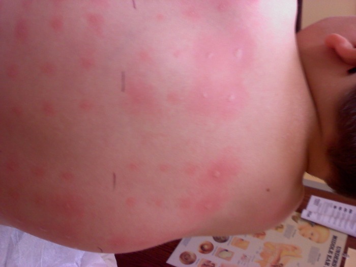My sons back after allergy testing