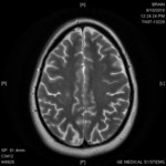 Brain Axial T2 26