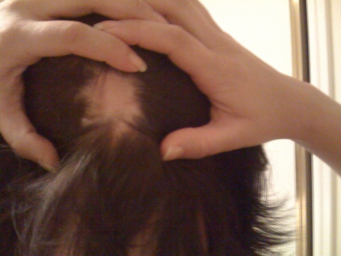This is where it all started - one day woke up with this little patch on the back of my head. 