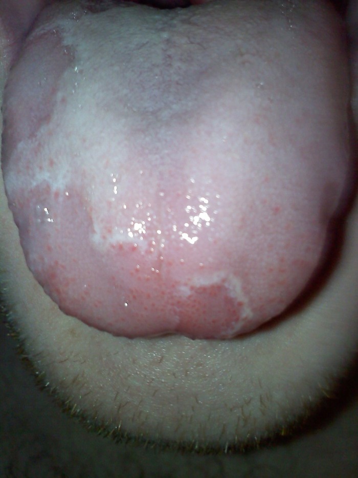 This is my geographic tongue. I am HIV, HSV-2, Syphilis, Chlamydia, and Gonorrhea negative.