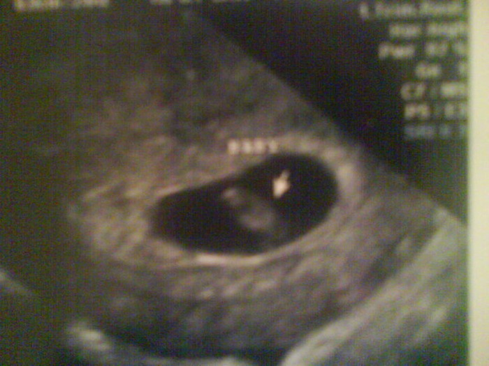 7 weeks 1 day Ultrasound