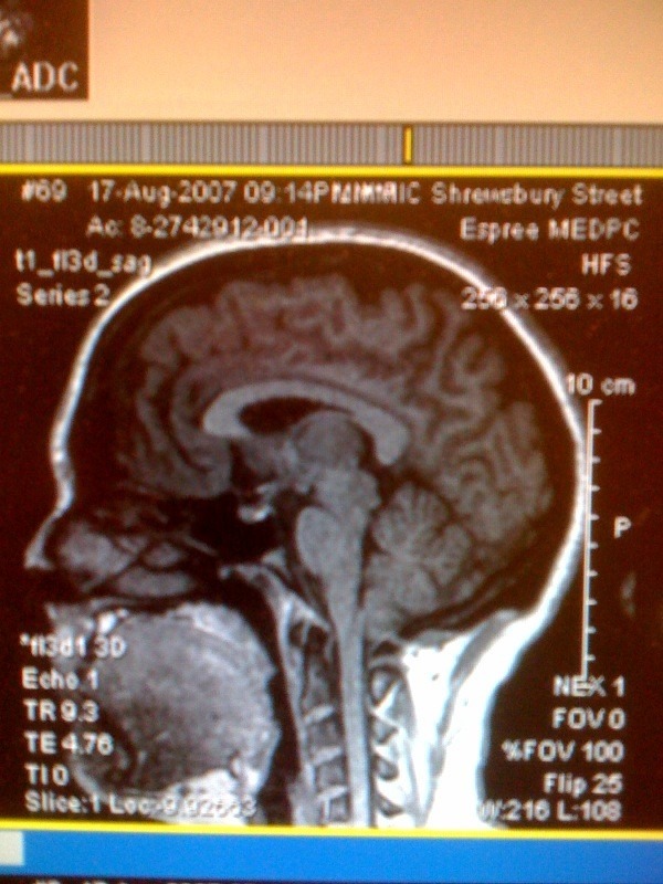 MRI from 2007... 4-5mm below FM