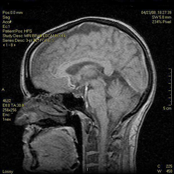 MRI of my brain,  See?  I have one!  Done 4/08