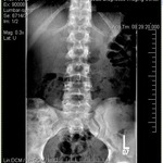 X-Ray of Lumbar Spine