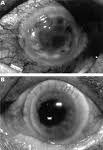 coagulative necrosis of cornea