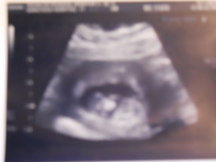 12 weeks ultrasound