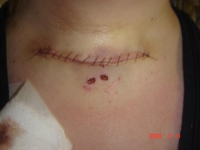 1 day after thyroid surgery