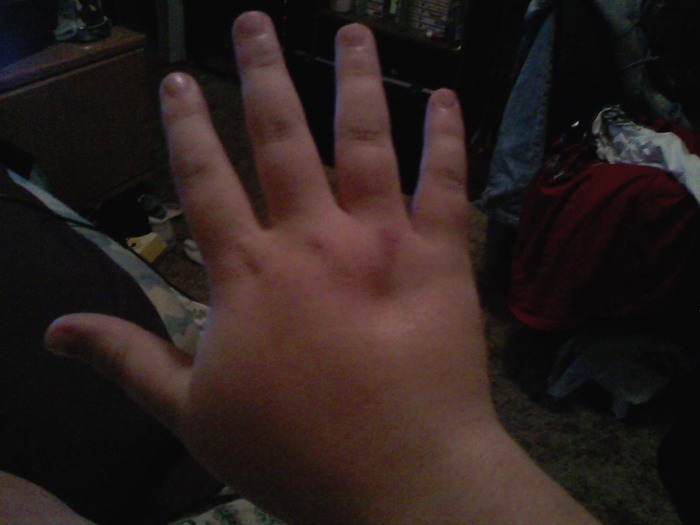 this is my bad hand after i put a little bit of pressure on it.
