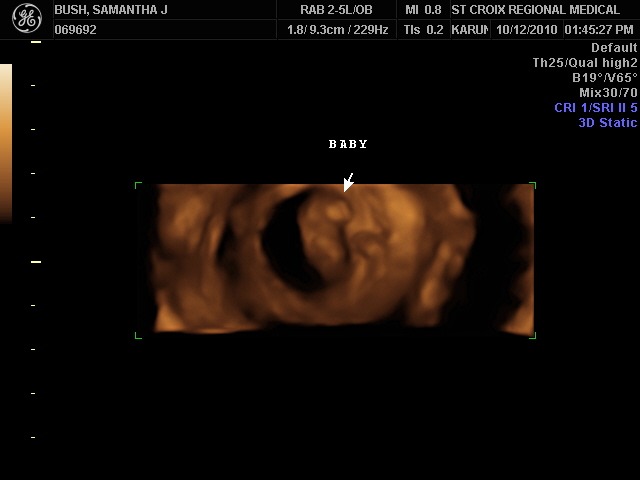 1st ultrasound, 9wks, 4days