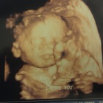 Baby A 3D 27 weeks
