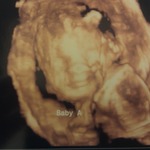 Baby A 3D U/S 27 weeks