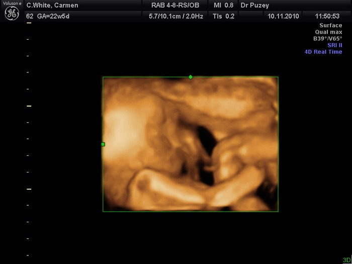 My baby girl @ 22 weeks & 5 days - got her arms wrapped around her thighs - all curled up!