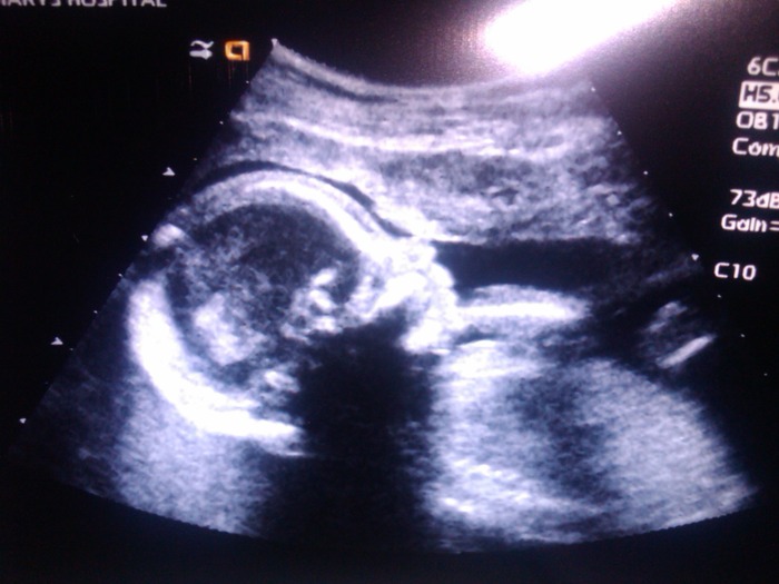 20 week ultrasound, 13 ounces