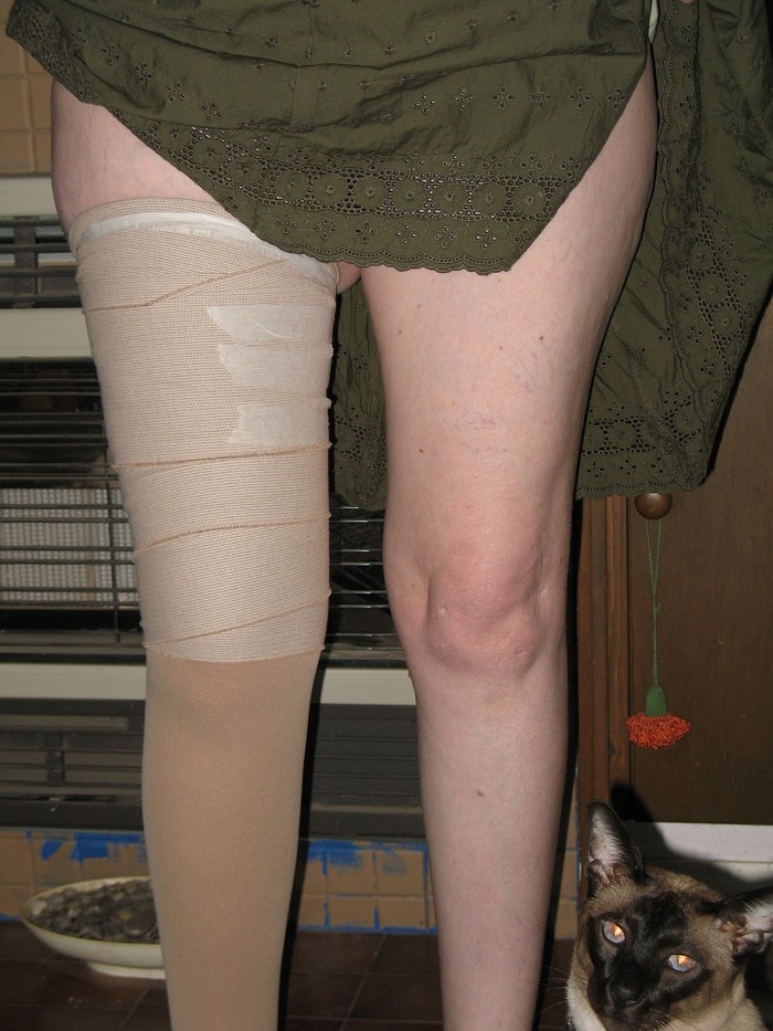 The sclerotherapy bandages and compression stocking. Big ouchies Dec 14 2010