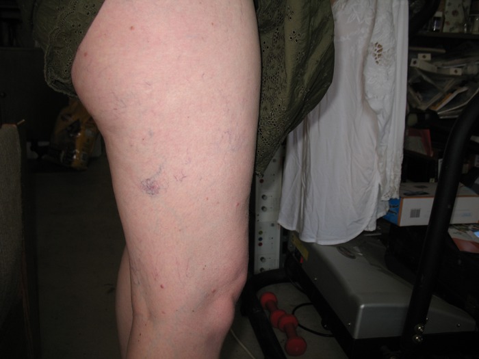 The 'Ooh you have a bruise on your leg' photo Before sclerotherapy today. Dec 14 2010