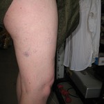 The 'Ooh you have a bruise on your leg' photo Before sclerotherapy today. Dec 14 2010