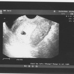 Our little one :) There was a gest sac, yolk sac and fetal pole though the pic is not good. 