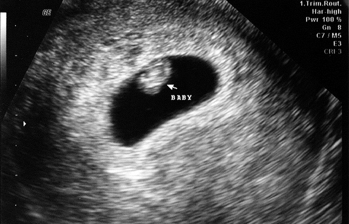 Jayden's first Ultrasound 6 weeks in March 2010