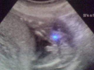 19 weeks Its a boy 