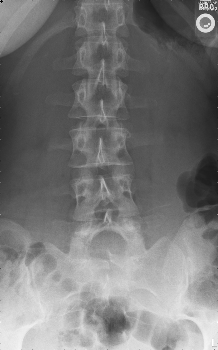 spina bifida occulta S1 and mild curvature 
