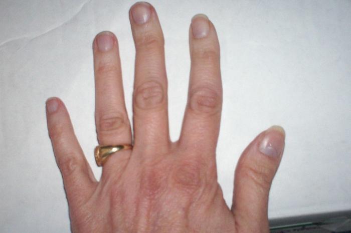 Change in nailcolor Left Hand,bluish