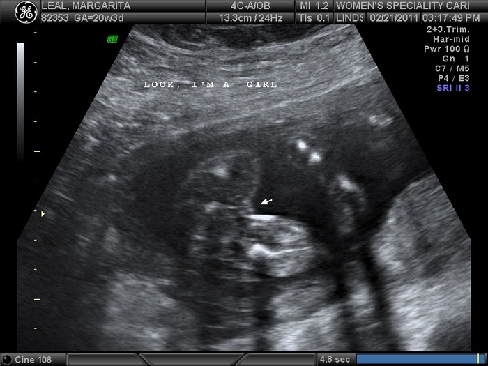 It's a girl!!!
