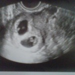 This is my first ultrasound that confirmed my TWINS!!!!!! 6 weeks and 5 days