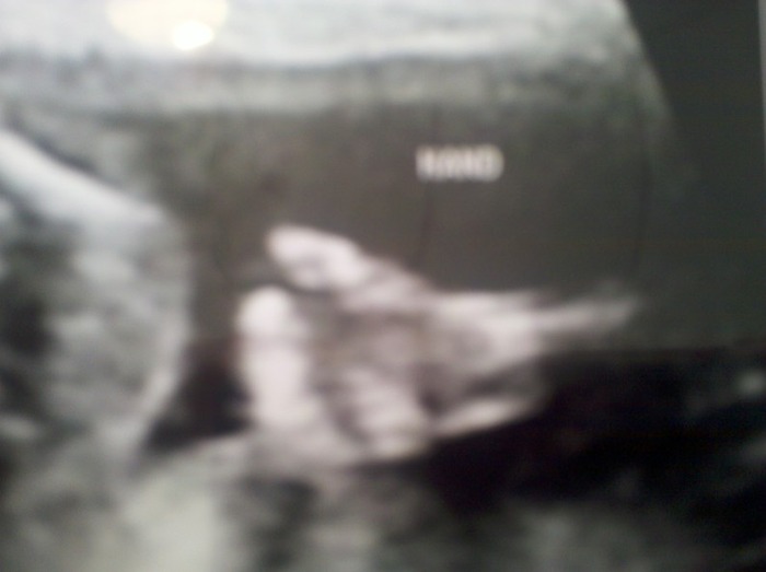 Tiny little thumbs up at our 20wks scan