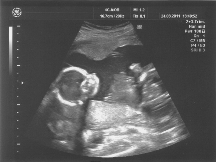 Our sweet miracle baby girl at 20w0d <3