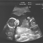 Our sweet miracle baby girl at 20w0d <3