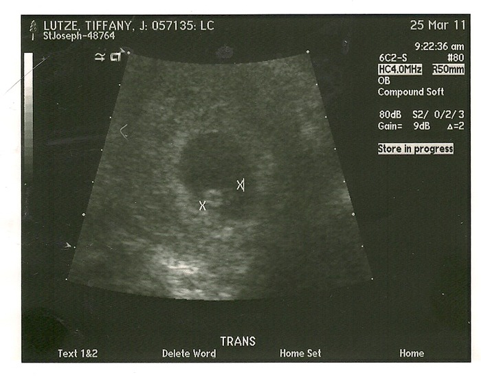 my first ultrasound heart beat was 160