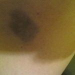 My poor leg after daily jabs, was shaking, hence the bruise!