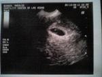 Just after i lost Baby B... Baby A there is a heartbeat 6 weeks