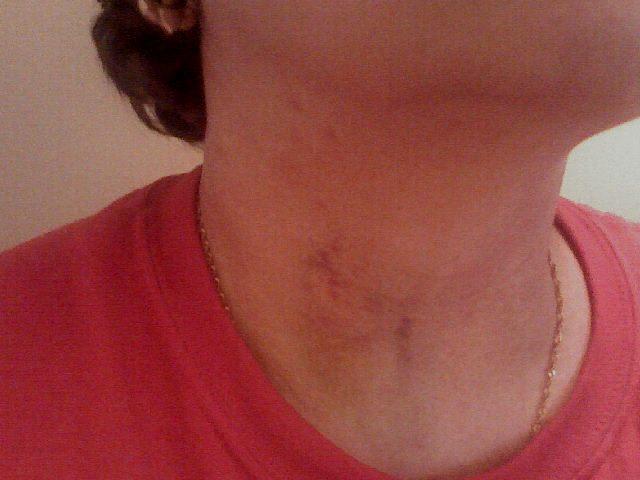 My neck 1 day after FNA