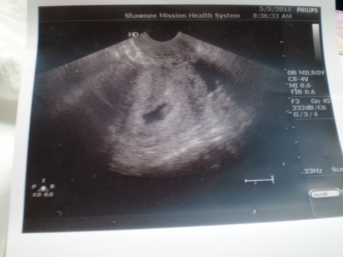 another 7 wks, 5 day photo -- heart was "blinking" on the sonogram -- so sweet!
