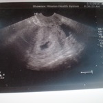 another 7 wks, 5 day photo -- heart was "blinking" on the sonogram -- so sweet!