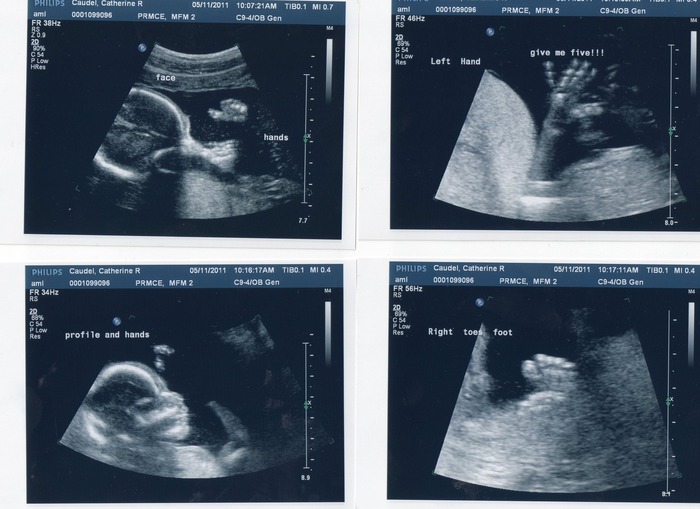 18 weeks ultrasound